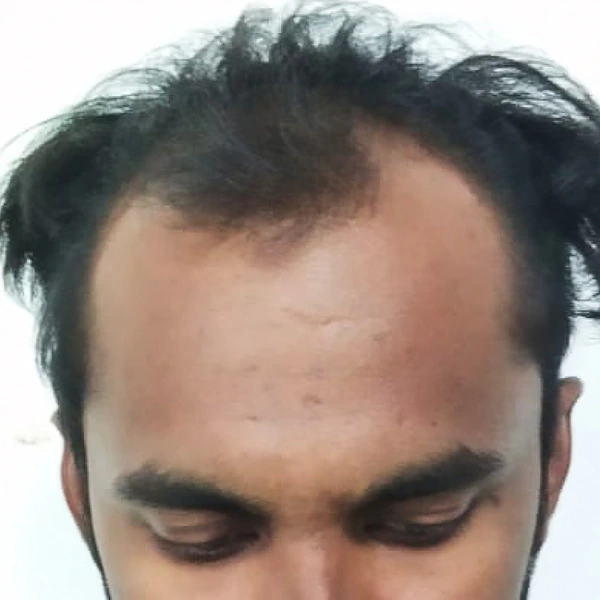 Male Pattern Baldness